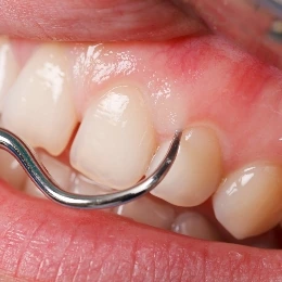 General and preventive dentistry treatment, illustrative photo