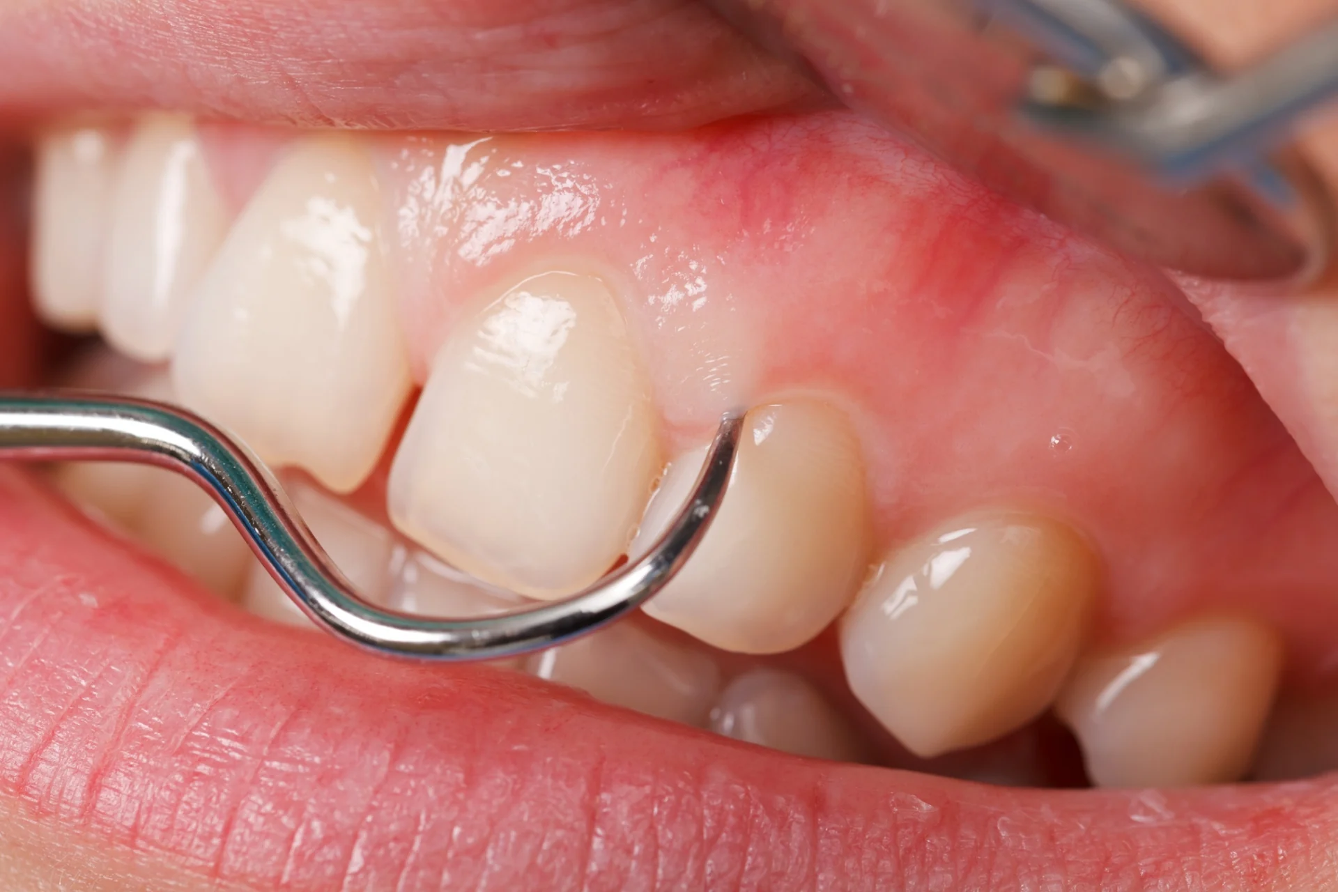 General and preventive dentistry treatment, illustrative photo