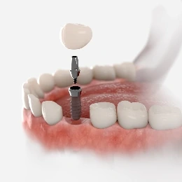 Dental implant treatment treatment, illustrative photo
