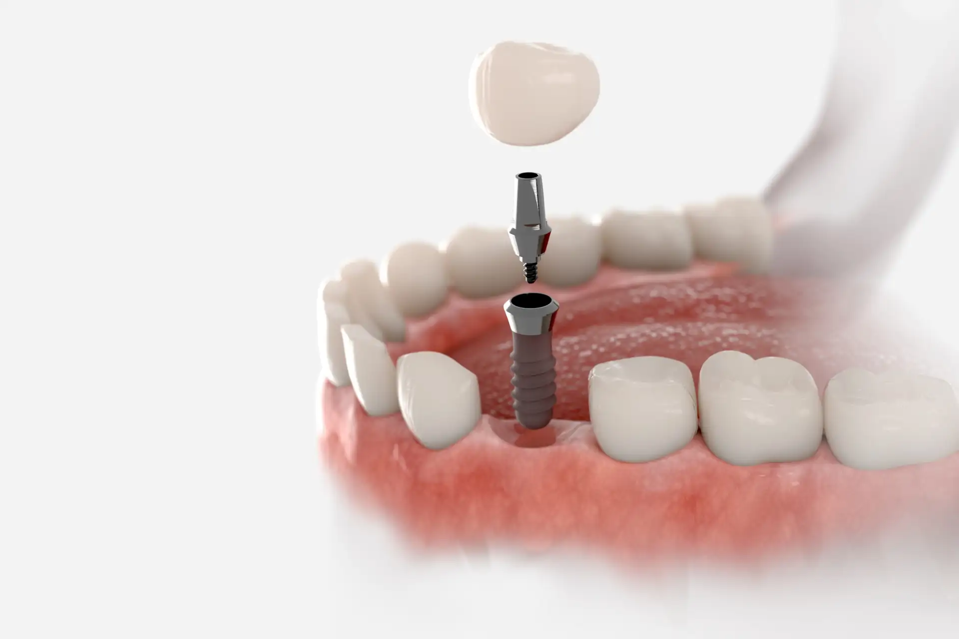 Dental implant treatment treatment, illustrative photo