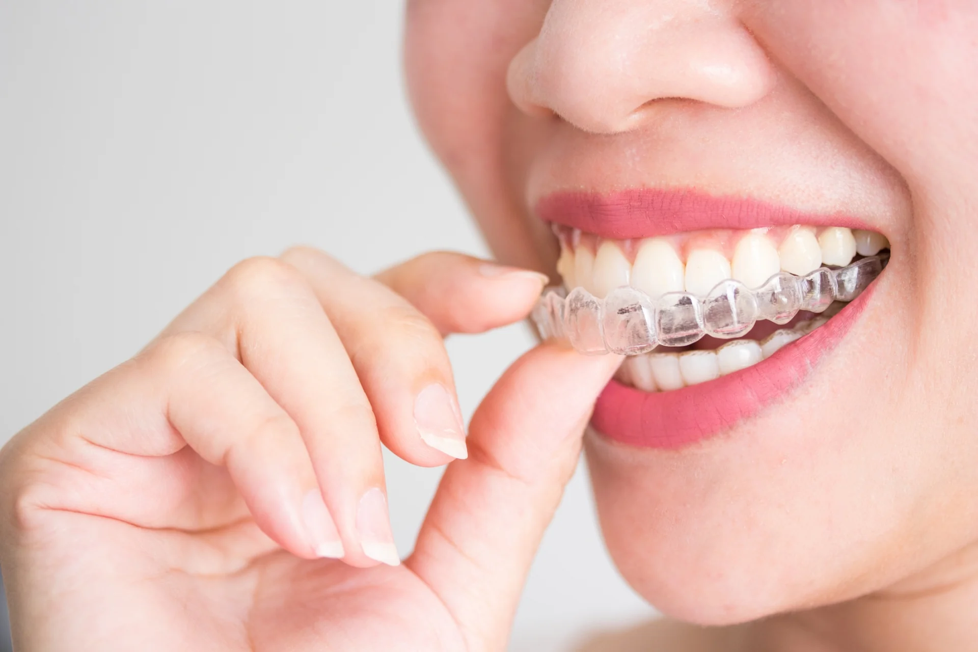Orthodontic treatment treatment, illustrative photo