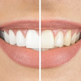Teeth whitening treatment, illustrative photo