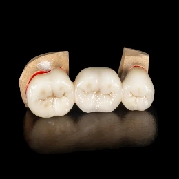 Zirconium crowns treatment, illustrative photo