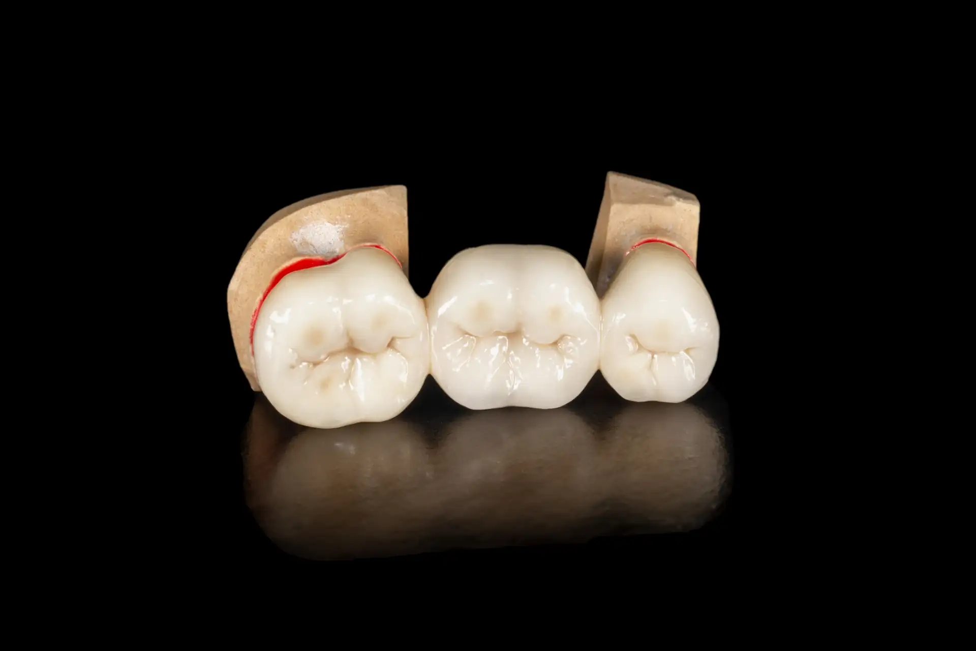 Zirconium crowns treatment, illustrative photo